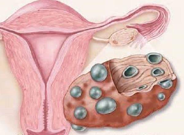 Поликистоз яичников при беременности: симптомы и лечение