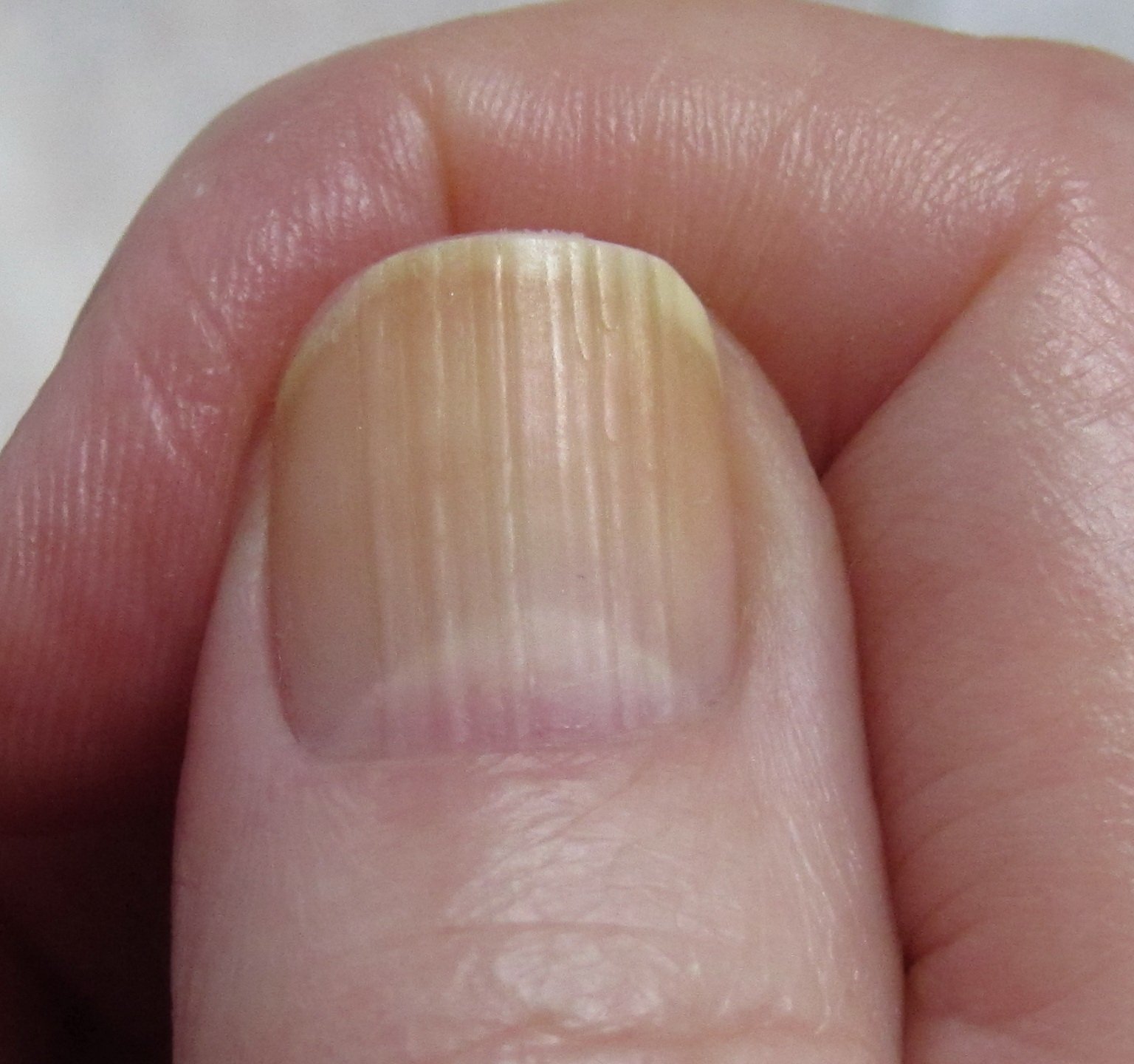 Полоски на ногтях причины вертикальные у женщин. Ониходистрофия, лейконихия. Поперечные борозды бо-Рейли. Ониходистрофия - онихолизис.. Микотическая лейконихия.