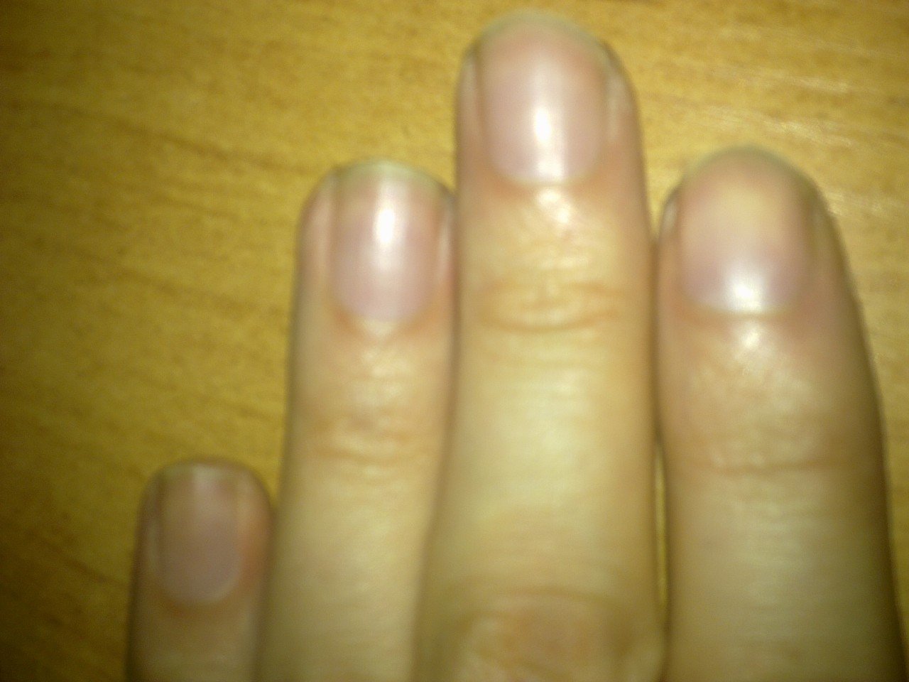 Что означают белые пятна на ногтях рук. Белые пятна на ногтях рук. Белые полоски на ногтях причины.