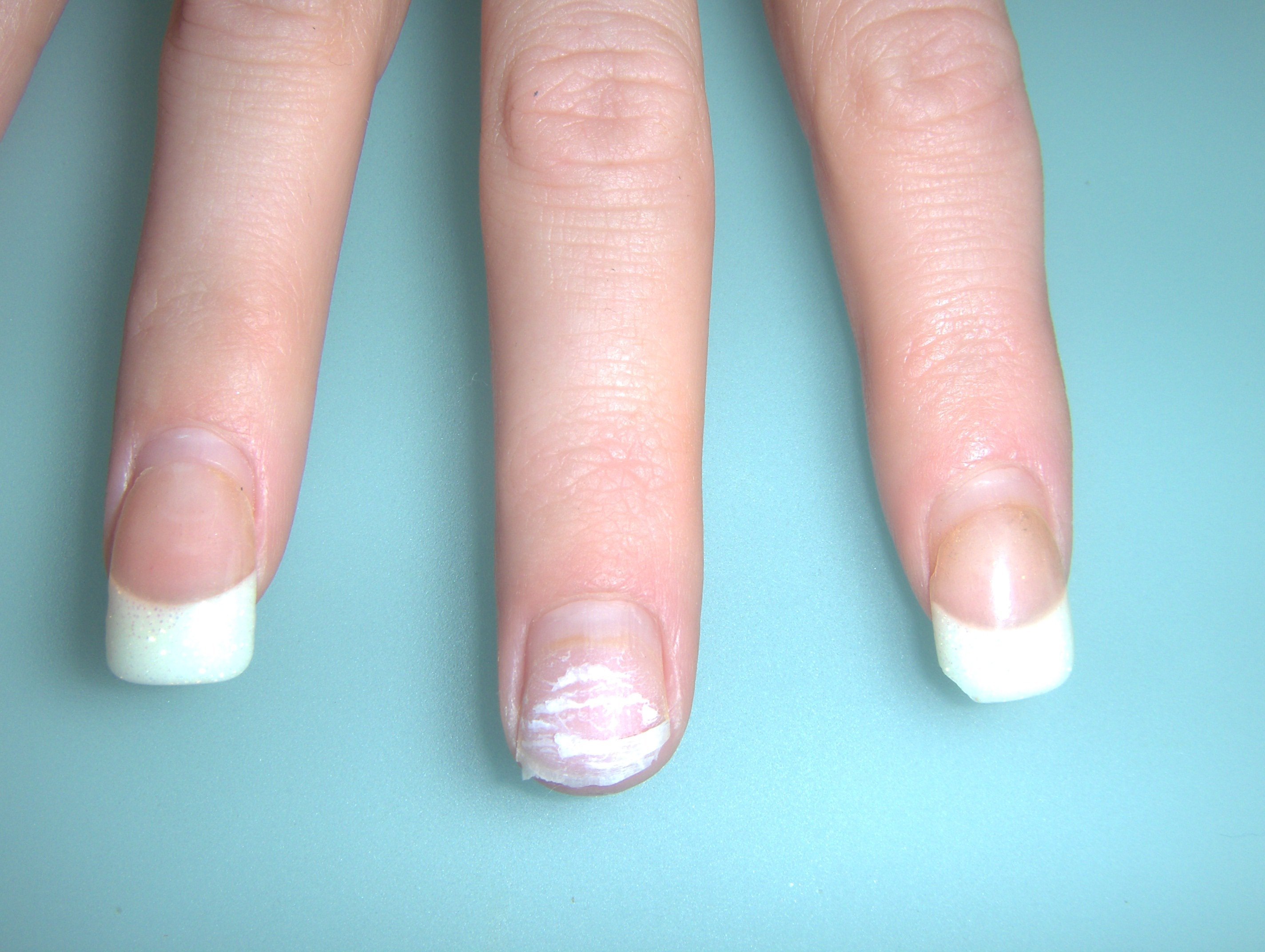 Портит ли ногти. Ногти после нарощенных ногтей. Ногти после снятия нарощенных. Ногти после наращивания. Неправильное наращивание ногтей.