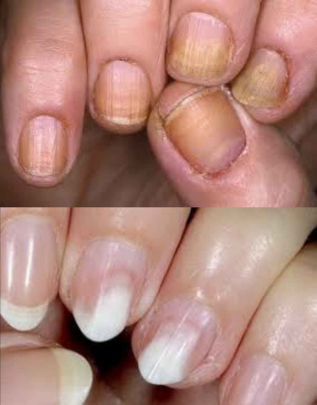 Почему ногти стали жесткими. Онихолизис синегнойная. Микотическая лейконихия. Ониходистрофия - онихолизис..