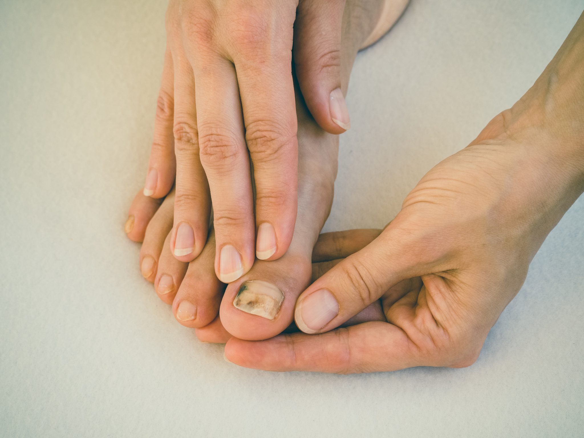 Педикюр больному. Подногтевой онихомикоз. Грибок ногтей на пальцах ног. Грибковые заболевания ногтей на ногах.