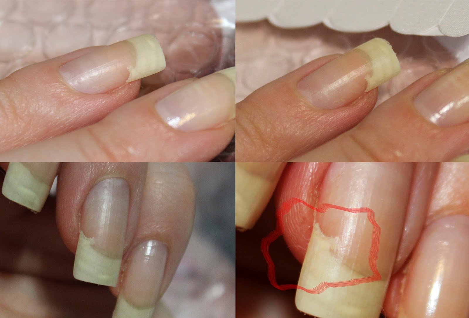 Восстановление сломанного ногтя