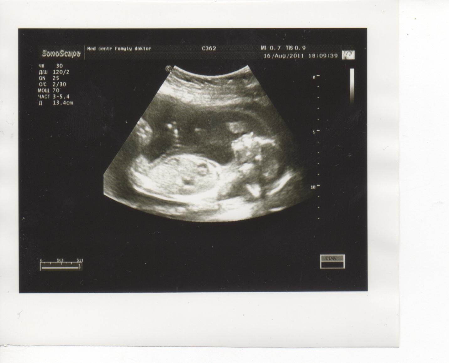 Бпр на узи при беременности. БПР на УЗИ 20 недель. Бипариетальный диаметр в 12 недель. Бипариетальный диаметр.