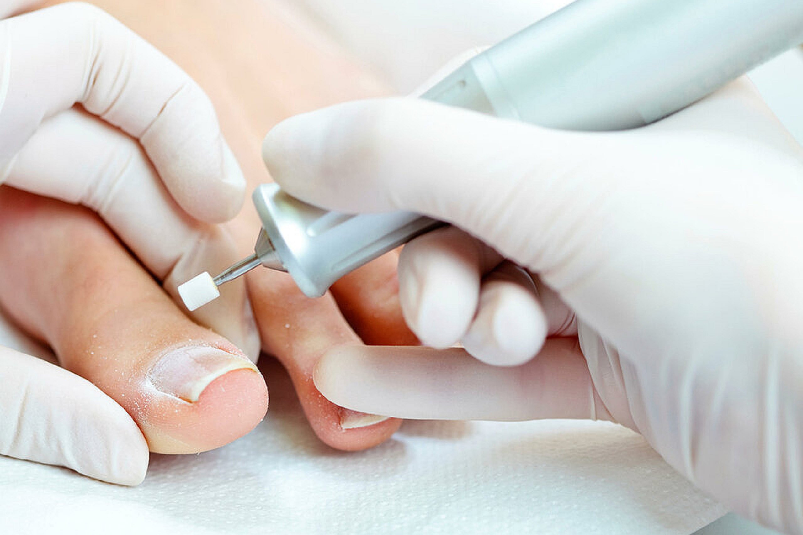Лечение грибка ногтя врач