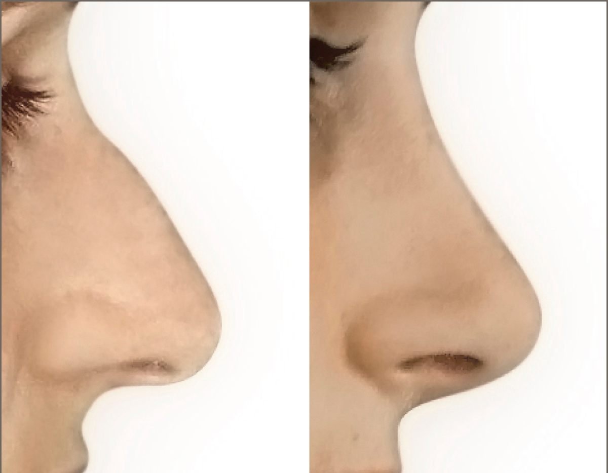 Глупый нос. Ринопластика орлиного носа. Красивая форма носа. Формы Носов. Женские формы носа.