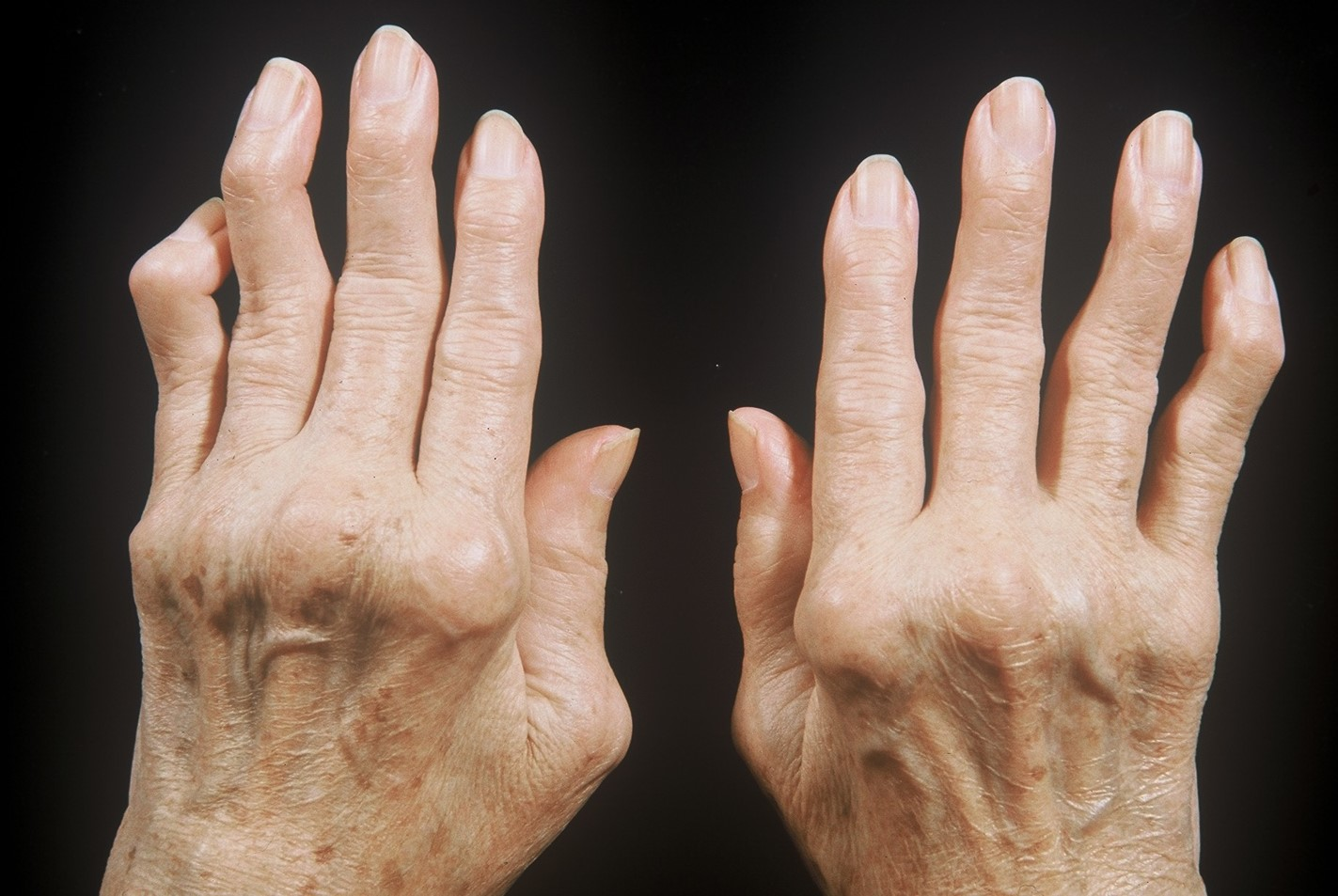 Brote de artritis en las manos
