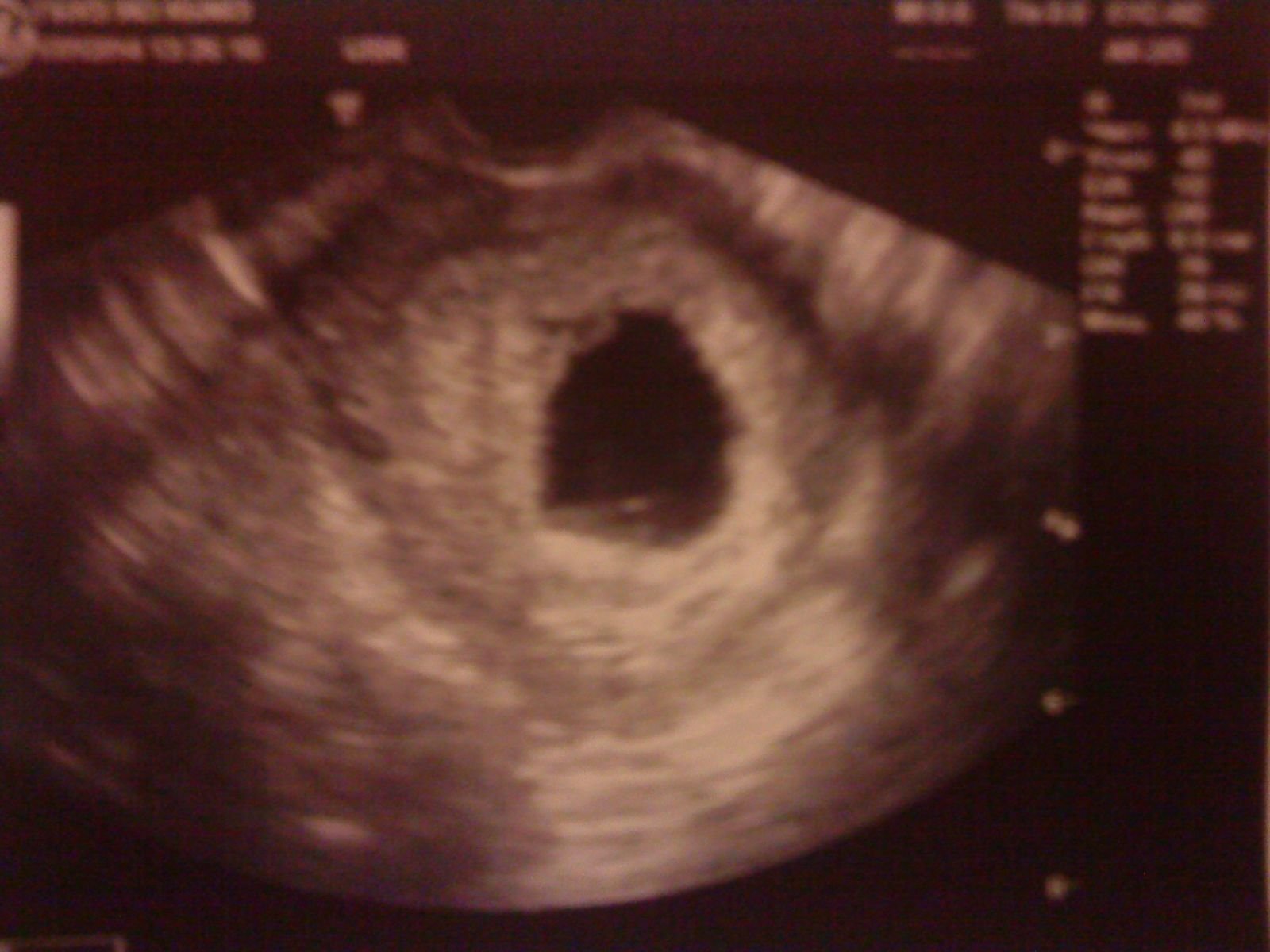 6 эмбриональная неделя. УЗИ 6 недель беременности. КТР 7 недель УЗИ. УЗИ 5-6 недель беременности.