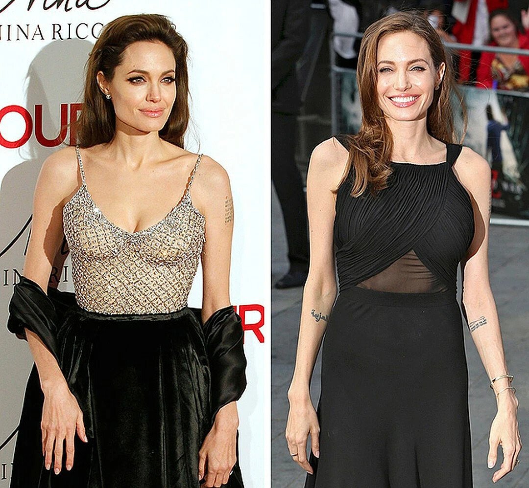 Мастэктомия Анджелины Джоли до и после