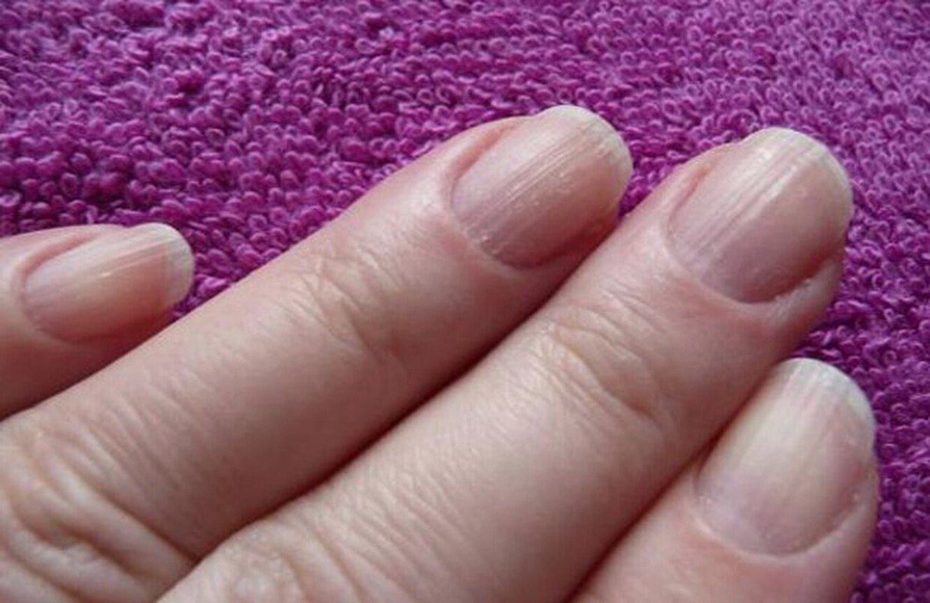 Признаки болезни по ногтям на руках с фото