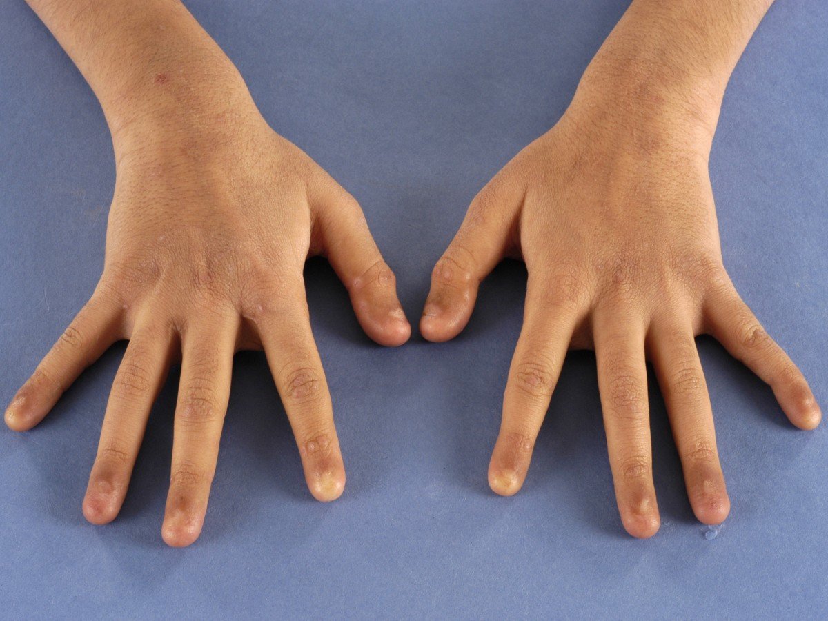 Пальцы становятся толще. Отсутствие ногтей на руках.
