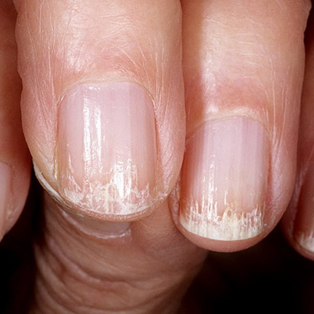 Почему ногти становятся тонкими. Ониходистрофия - онихолизис.. Микотическая лейконихия. Онихошизис слоятся ногти. Ониходистрофия (дистрофия ногтей).