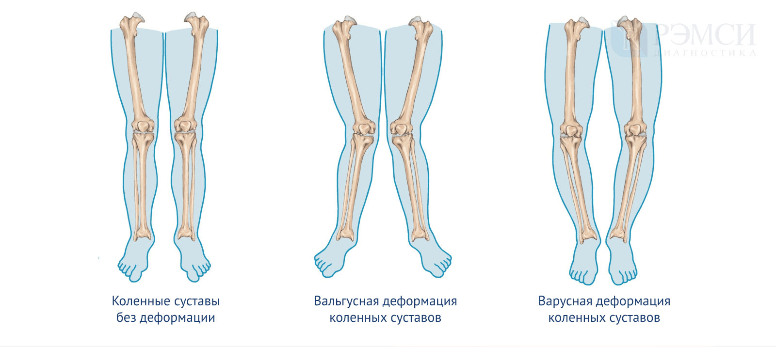 Какая нога. Варусная деформация оси нижних конечностей. Варусная деформация коленных суставов рентген. Сгибательная и вальгусная деформация коленных суставов. Варусная и вальгусная деформация коленного сустава.