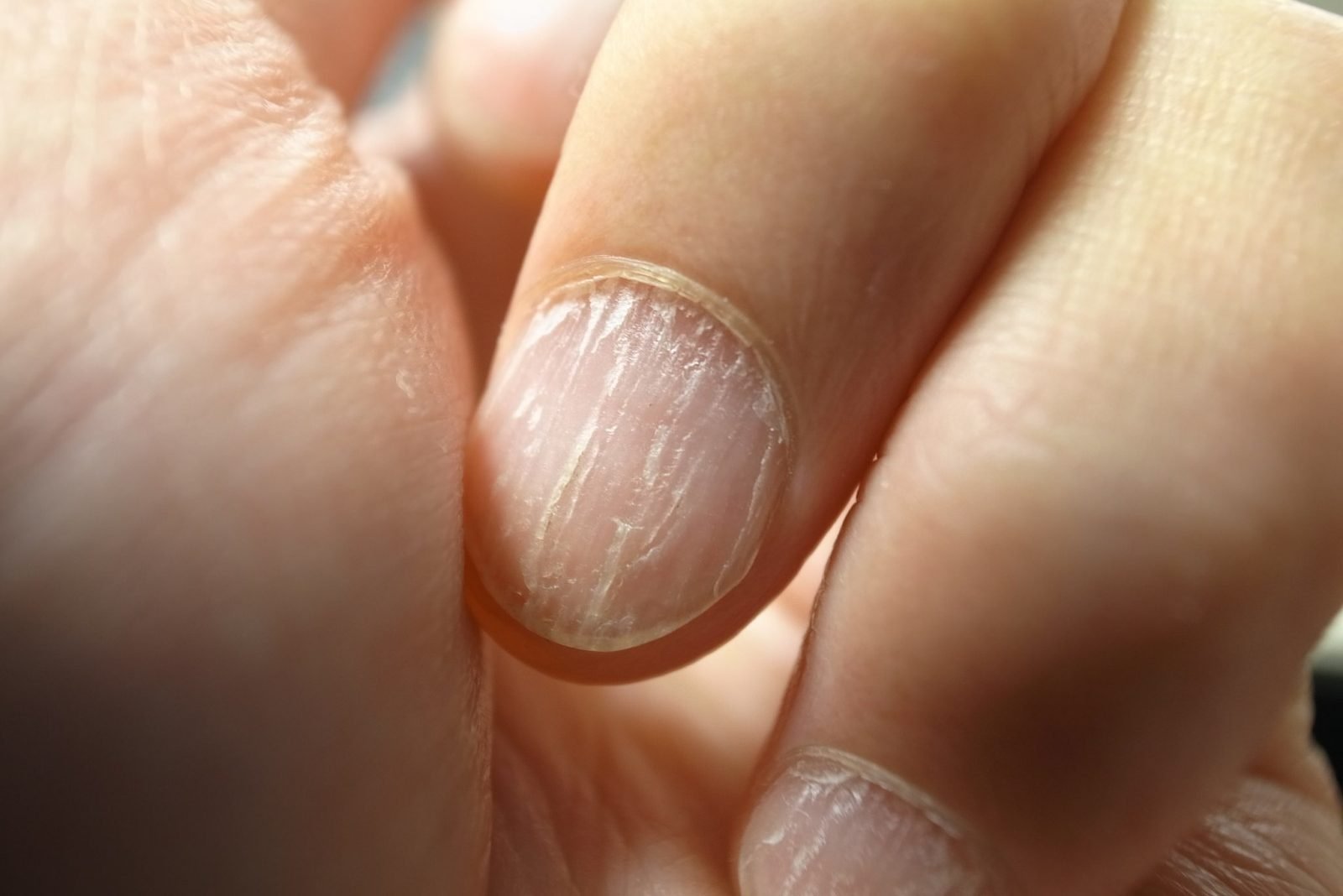 Почему слоятся ногти и что делать. Ониходистрофия - онихолизис..
