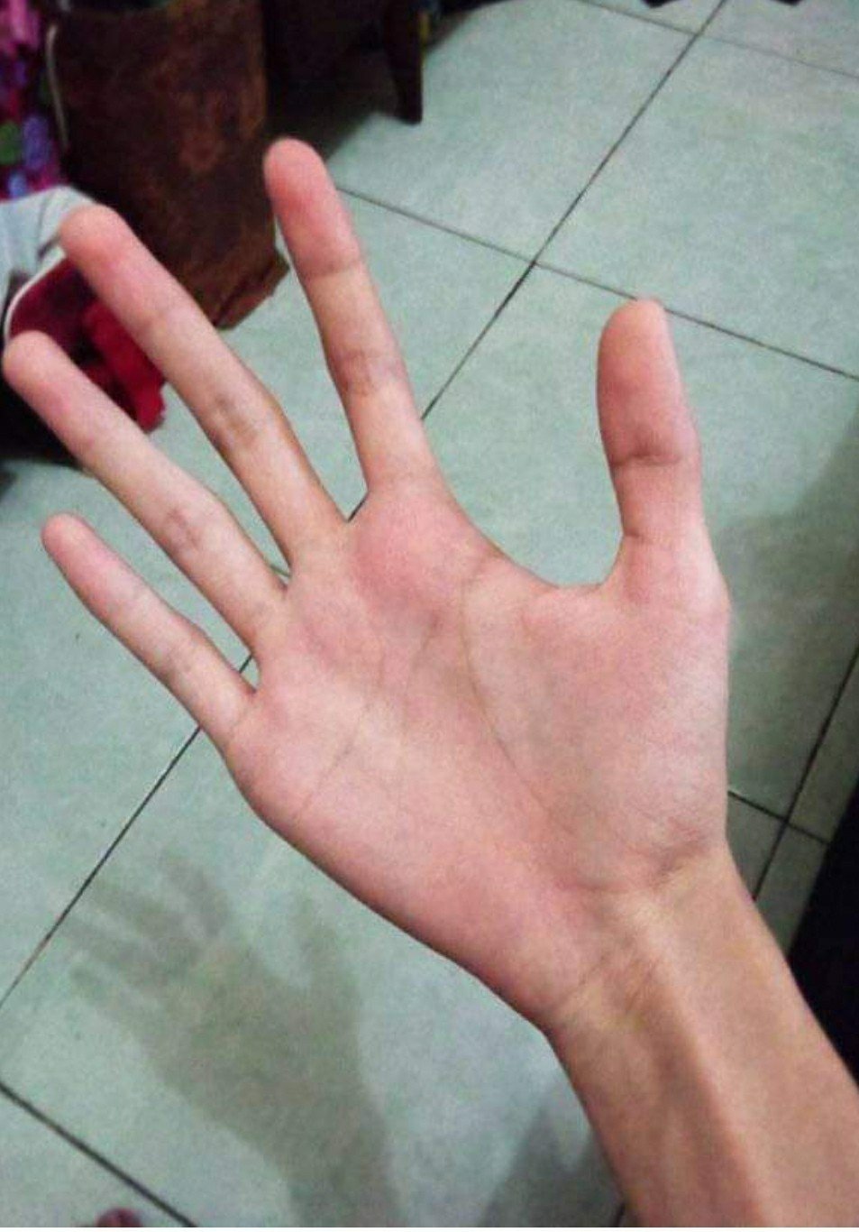Тонкий пальчик. Арахнодактилия паучьи пальцы. Длинные пальцы синдром Марфана. Арахнодактилия Марфана. Синдром Марфана (арахнодактилия).