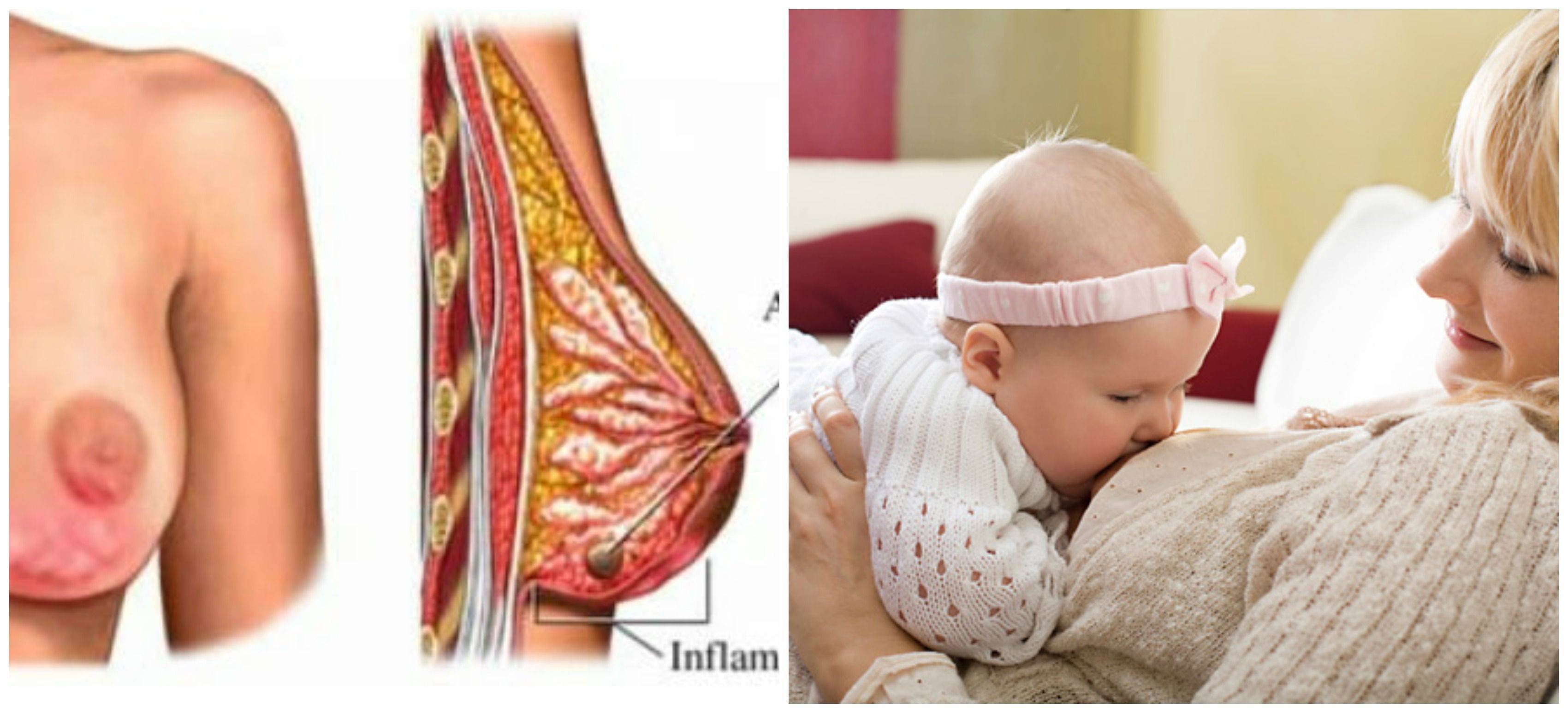 болезни груди у кормящей мамы (120) фото