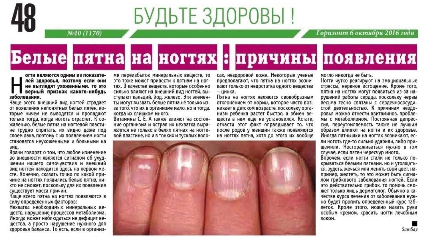 Что означают белые пятна на ногтях рук. Белые пятна на ногтях причины. Почему на ногтях появляются белые пятна. Поперечные полосы на ногтях.