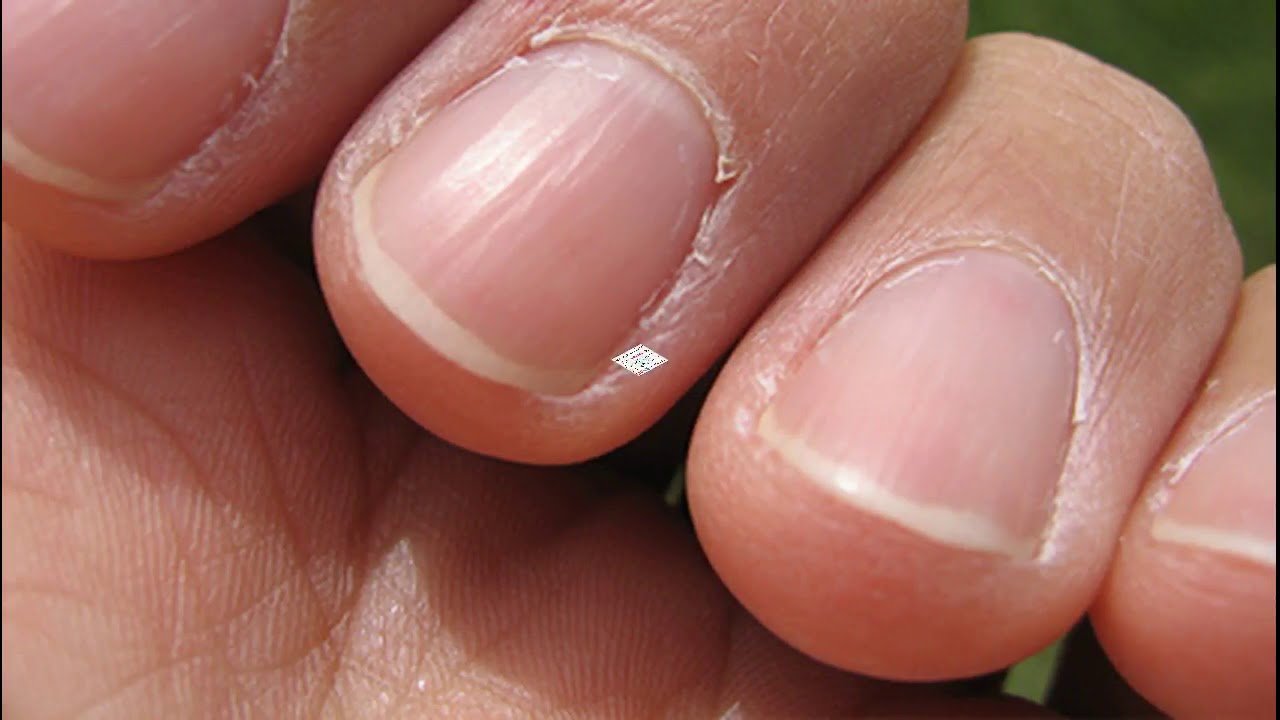Маникюр трещины. Короткие ногти на руках. Ногтевая пластина. Маленькие ногтевые пластины.