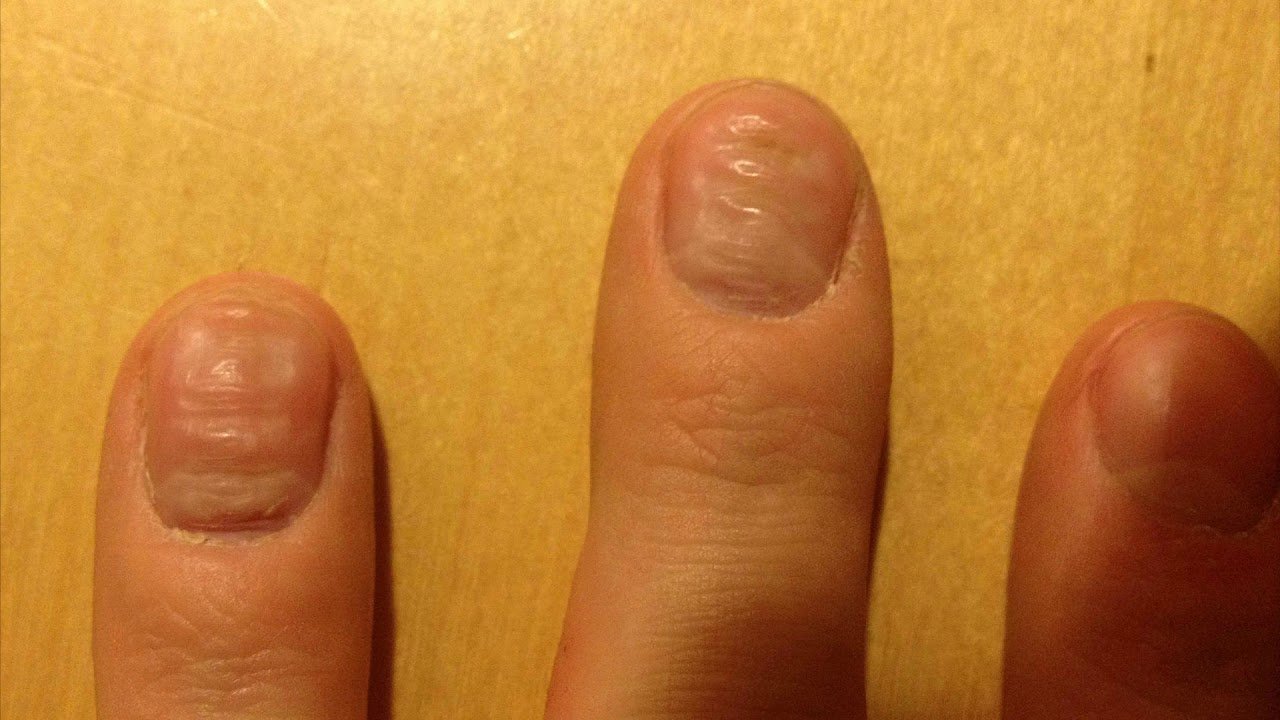 Ребристые ногти причина у мужчин