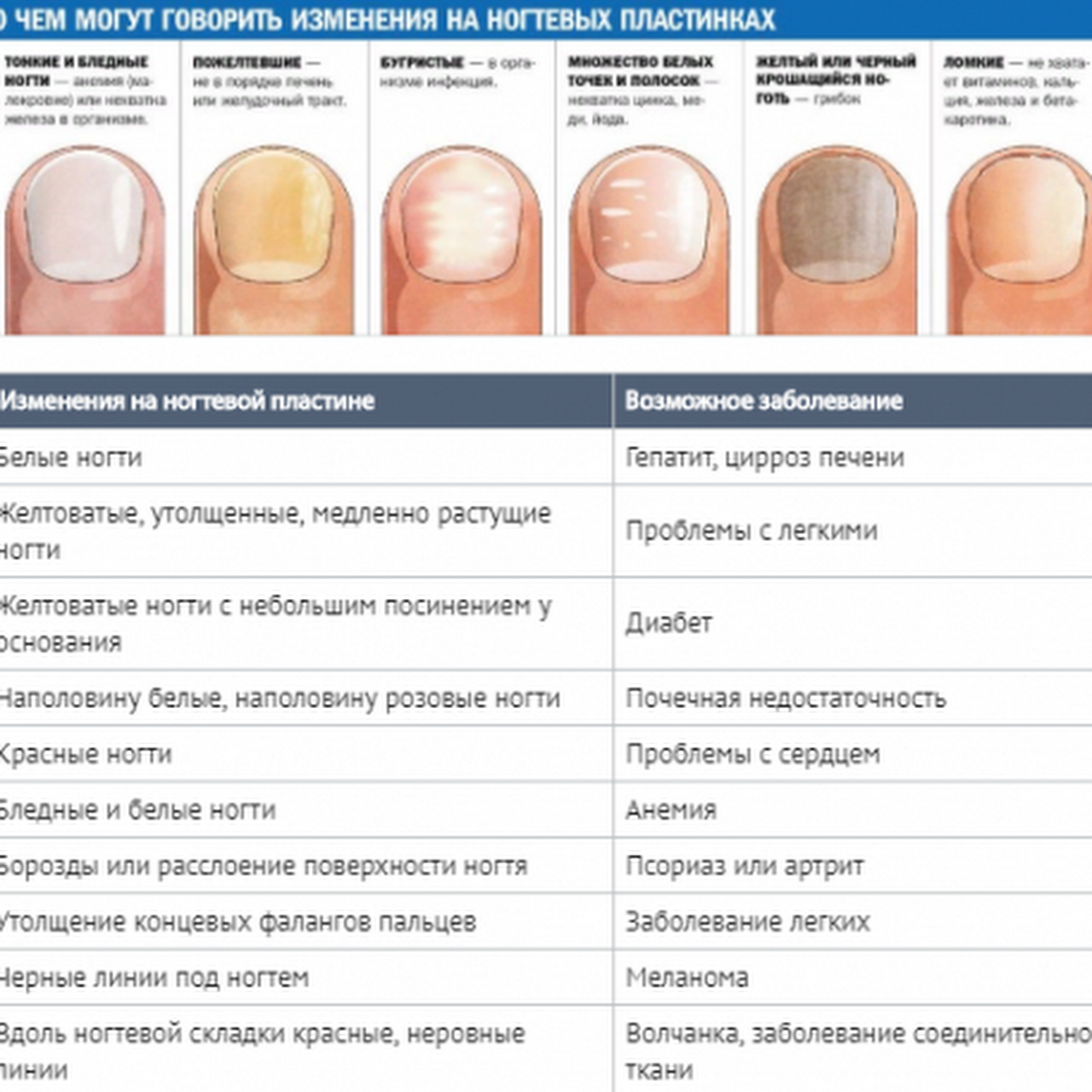 Почему на ногтях появляются продольные. Определение болезни по состоянию ногтей. Заболевания ногтей на руках таблица описание. Как определить по цвету ногтей заболевание. Выявление болезни по ногтям.