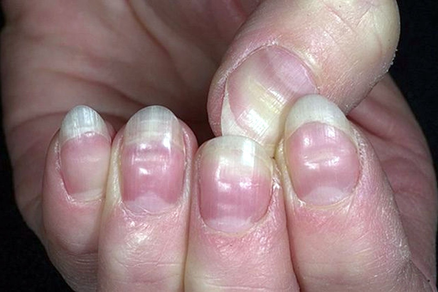 Ногти стали толстыми и твердыми. Ониходистрофия - онихолизис.. Поперечные борозды бо-Рейли. Каналообразная дистрофия ногтей. Синегнойная Псевдомония.
