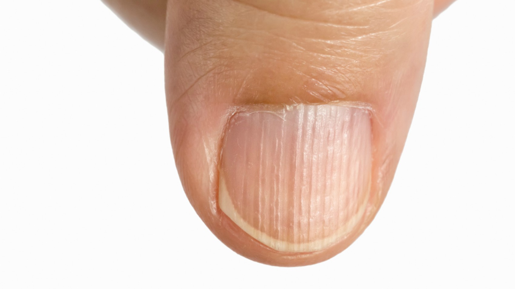 Что означают полосы на ногтях. Ониходистрофия - онихолизис.. Ониходистрофия борозды. Ониходистрофия (дистрофия ногтей).