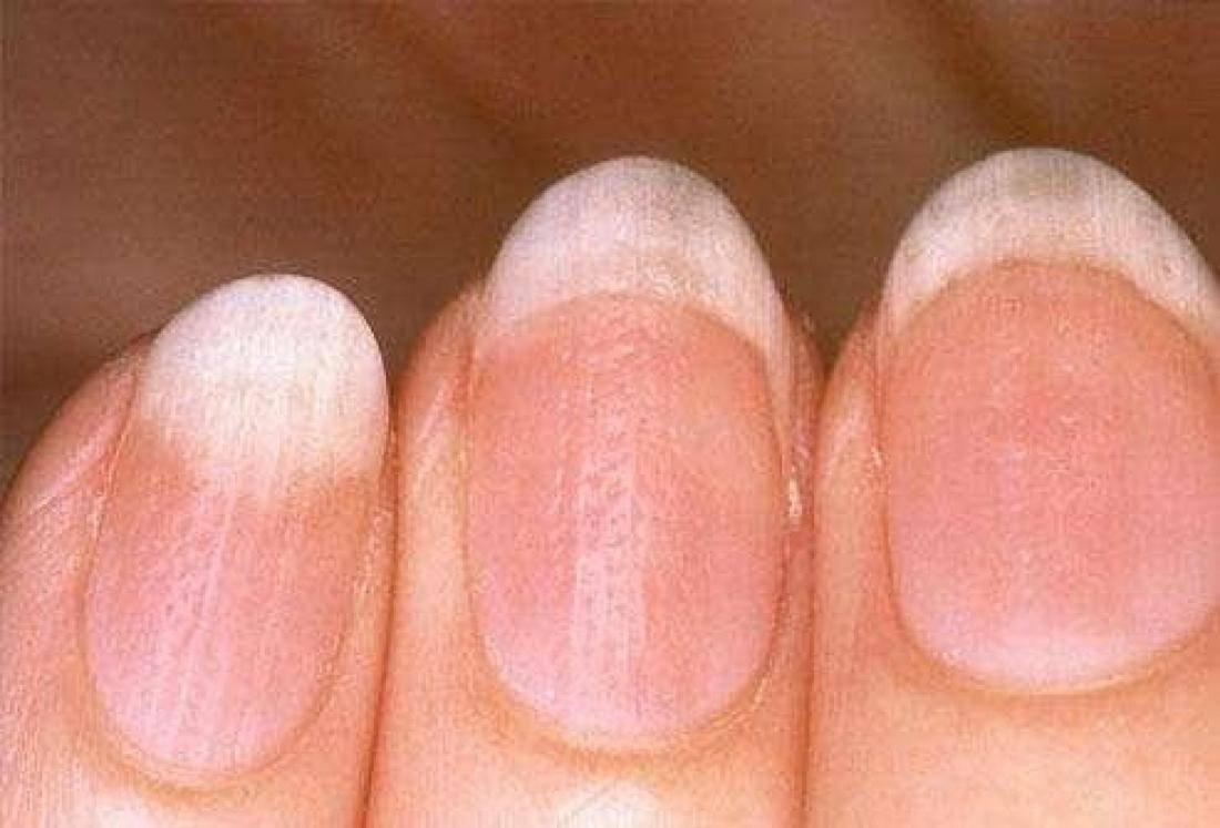 Humedad en las uñas