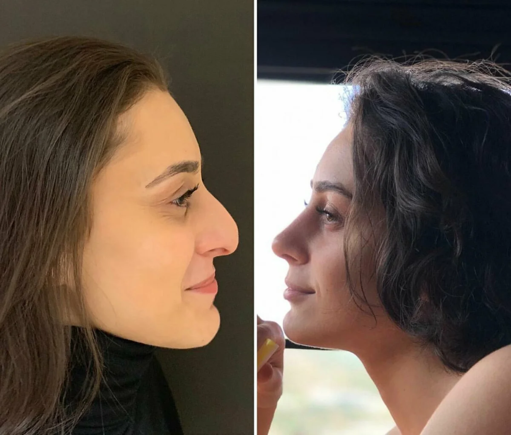 Фото ринопластики до и после нос. Хайбула Камилович ринопластика. Ахмед Дилбер ринопластика. Ринопластика большого носа с горбинкой.