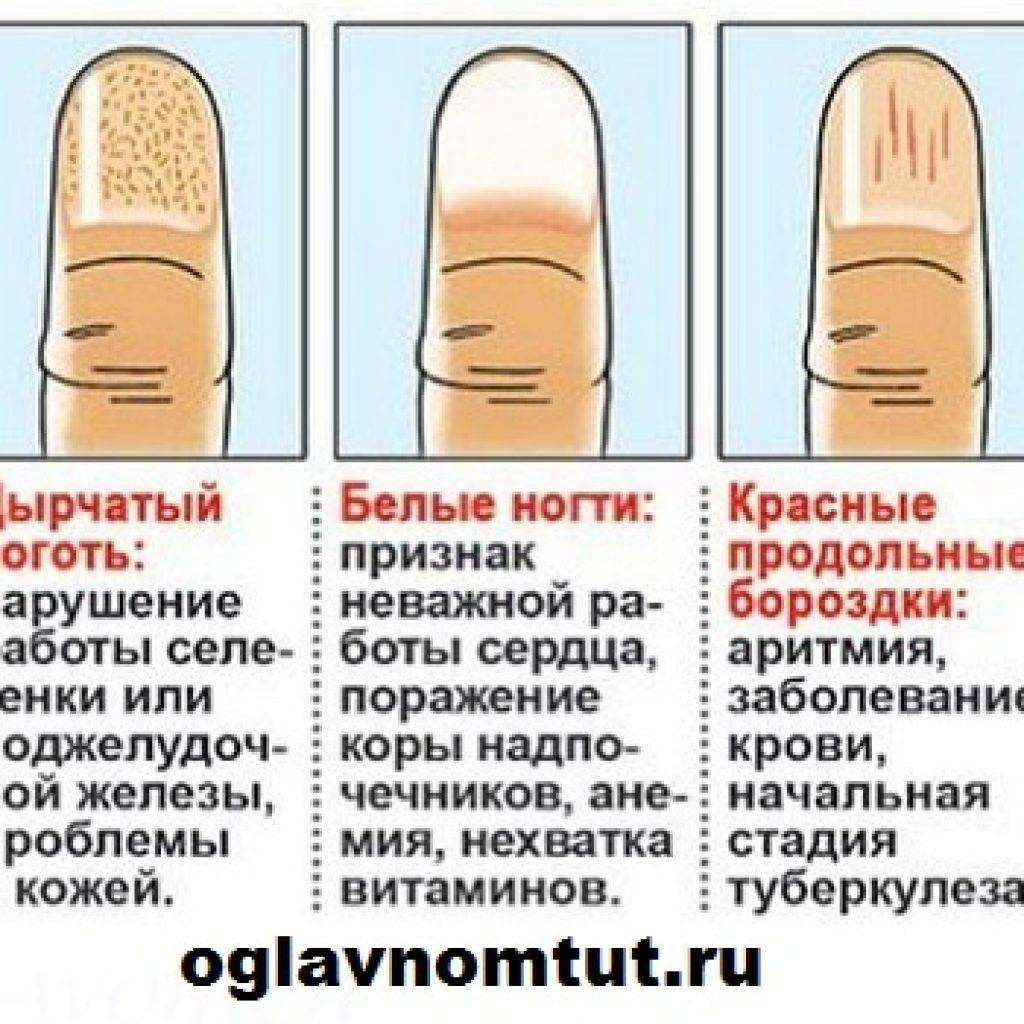 Что означают полосы на ногтях. Белая продольная полоса на ногте. Полоска на ногте вертикальная.