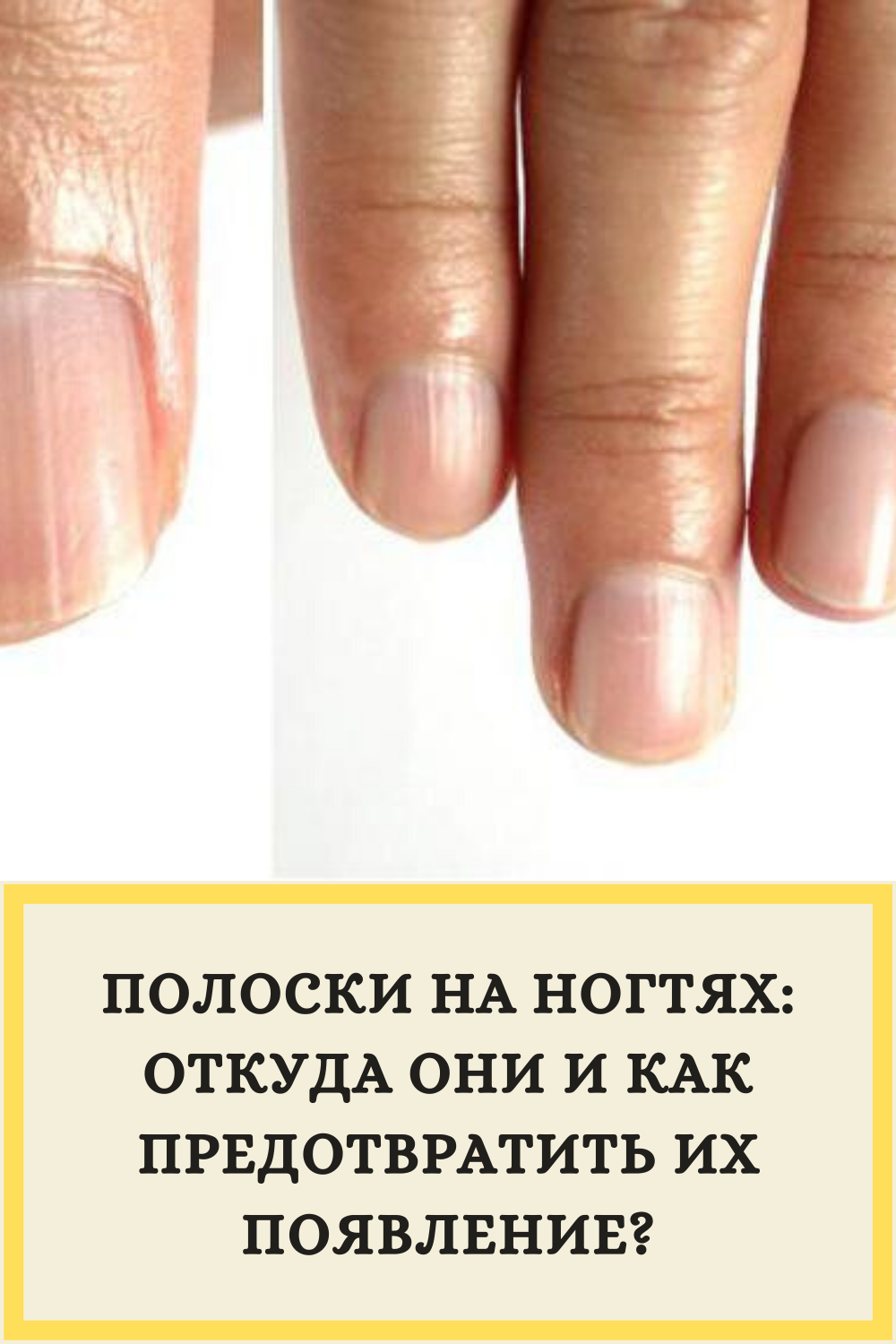 Полоски на ногтях причины вертикальные у женщин. Поперечные полосы на ногтях. Поперечные белые полоски на ногтях. Продольные полосы на ногтях. Поперечные борозды на ногтях.