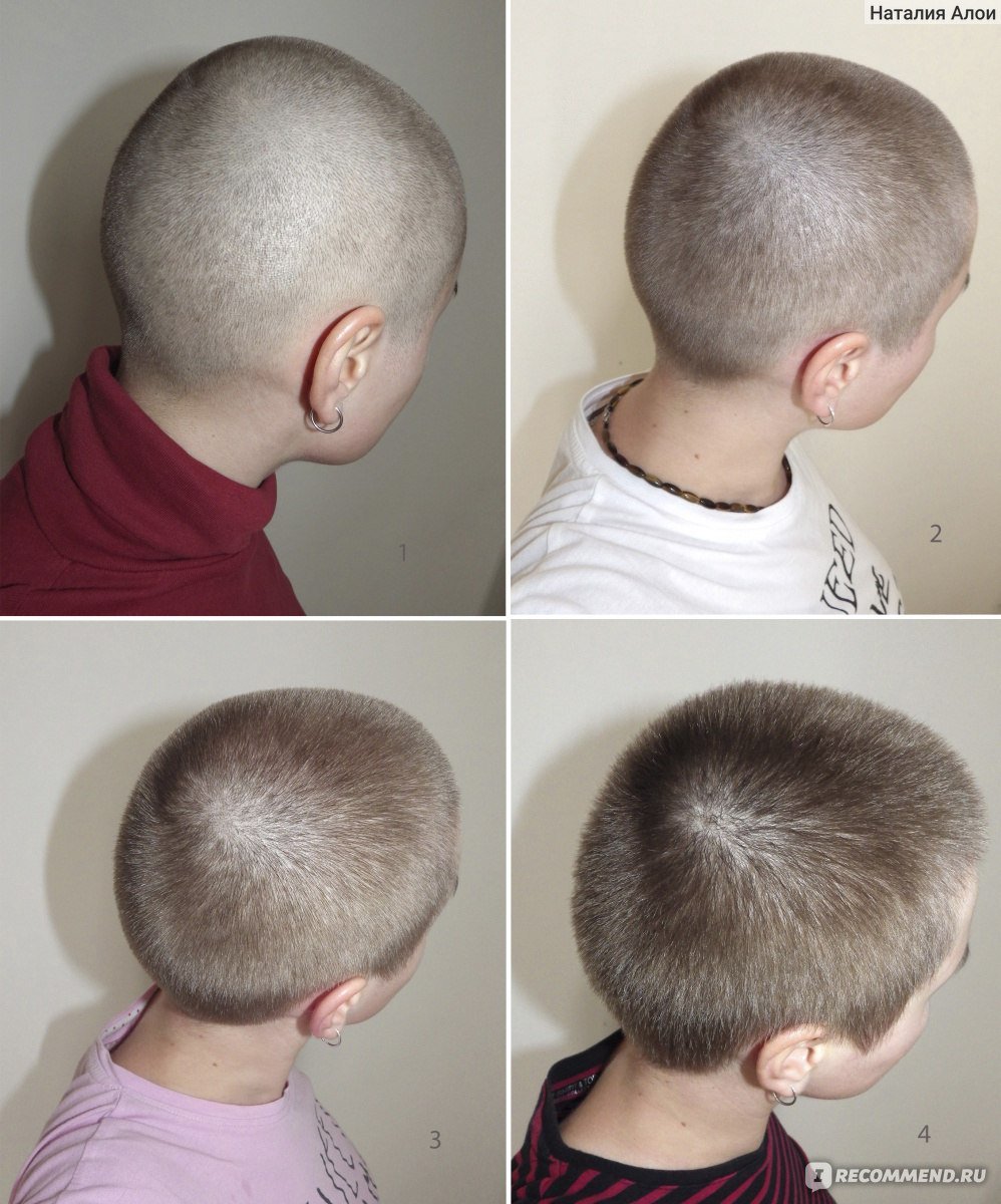 Сколько отрастают волосы у мужчин. Рост волос с лысины по месяцам. Стрижка для мальчика на отросшие волосы. Стрижки для роста волос. Рост волос на лысой голове.