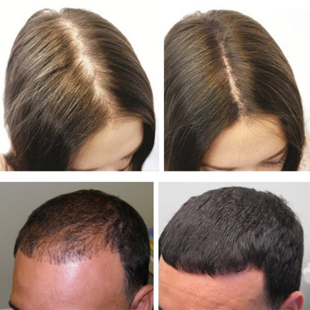 Препарат для восстановления волос облысения