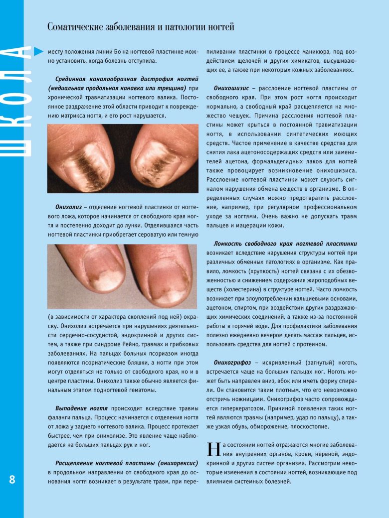 Что означают белые пятна на ногтях рук. Определить болезнь по ногтям.